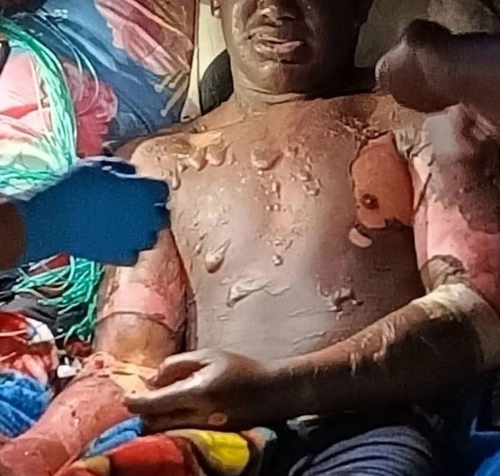 Deslave de arena caliente deja 4 personas heridas en la Comunidad Indígena Morichal, El Dorado, Estado Bolívar