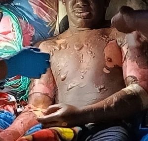 Deslave de arena caliente deja 4 personas heridas en la Comunidad Indígena Morichal, El Dorado, Estado Bolívar